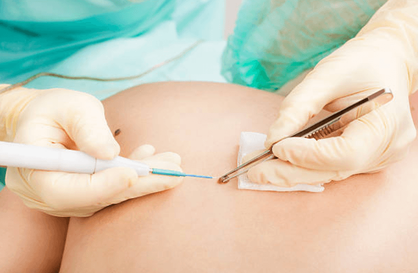 Professional Mole Removal Essex for Improved Skin Appearance Today